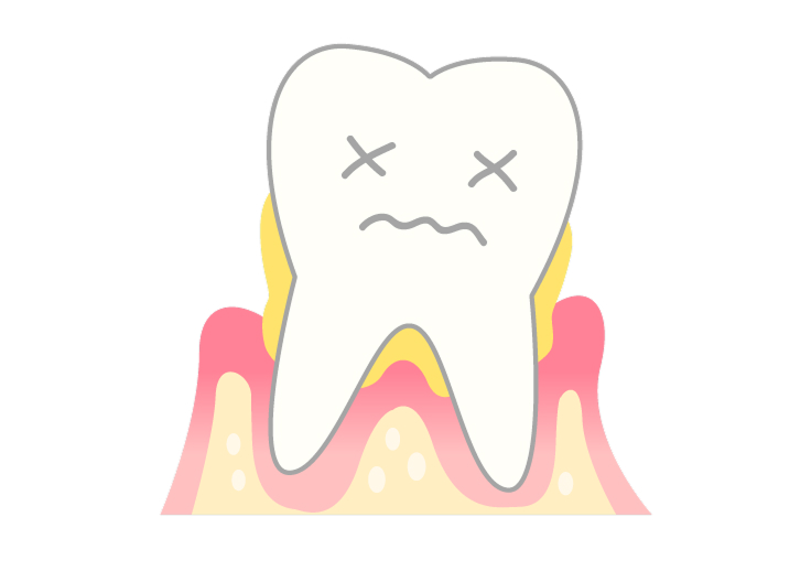 歯がグラグラと揺れ始める