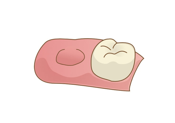 歯が脱臼し最終的に抜けてしまう