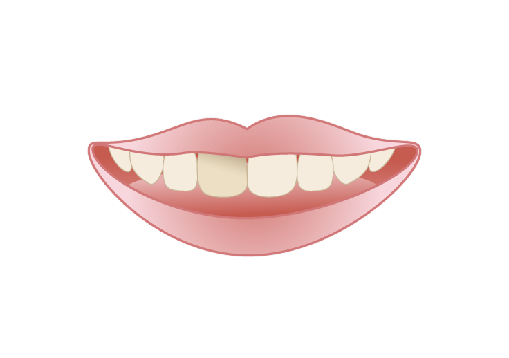 神経が傷つき、歯が変色する