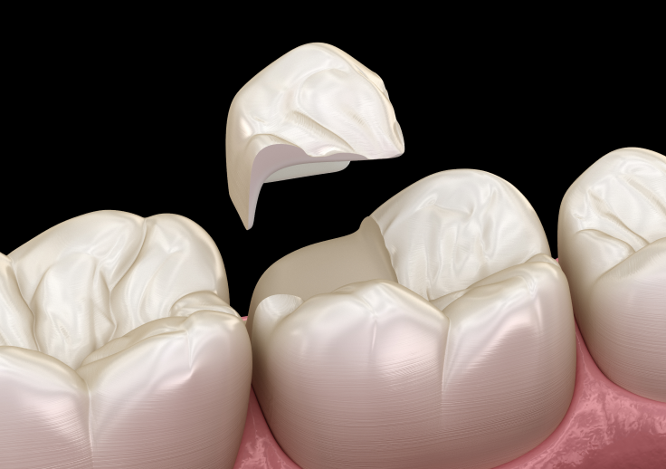 コンポジットレジン・セラミックによる修復