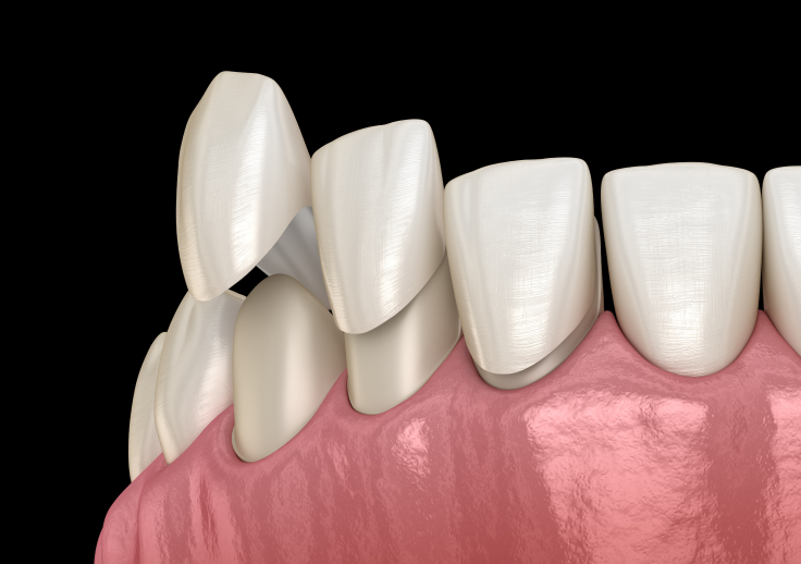 差し歯（クラウン）